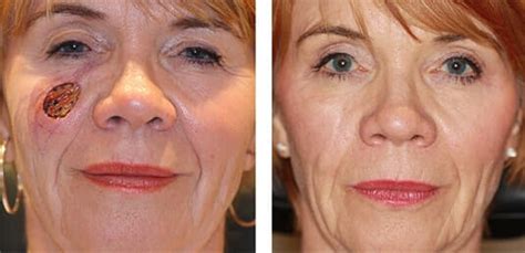 Before And After Skin Cancer Reconstruction Surgery Photos Dr Michael Mccracken