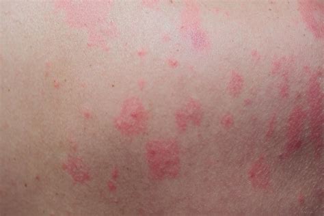 Premium Photo Close Up Allergy Rash Around Back View Of Human With