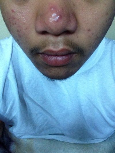 What Is The Best Treatment Suited For These Raised Acne