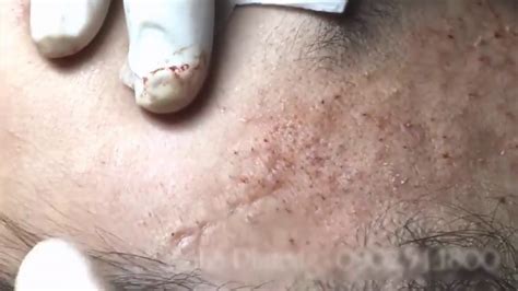 Best Of The Blackheads On The Forehead Youtube