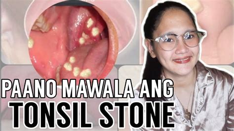 Paano Mawala Ang Tonsil Stone How To Get Rid Tonsil Stone Youtube