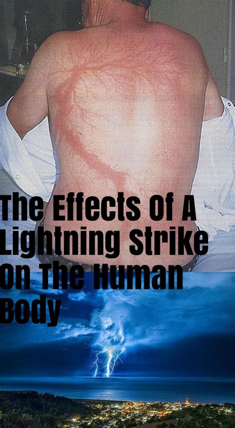 The Effects Of A Lightning Strike On The Human Body Lightning Strikes Human Body Lightning