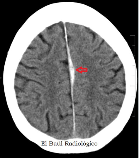 Hematoma Subdural Laminar