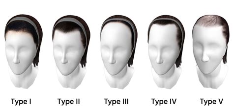 The Different Types Of Hairlines Human Hair Exim