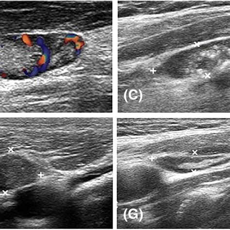 Sonographic Features Of Lymph Nodes The Suspicious Malignant Features