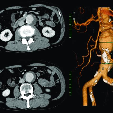 Contrast Enhanced Ct Scanning Revealed An Abdominal Aortic Aneurysm