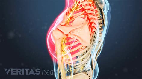 Could That Shoulder Pain Really Stem From The Neck