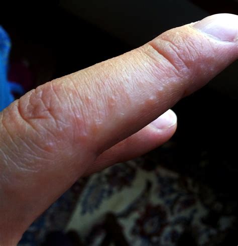 Often Sidelined As The Skin Manifestation Of Celiac Disease Dermatitis