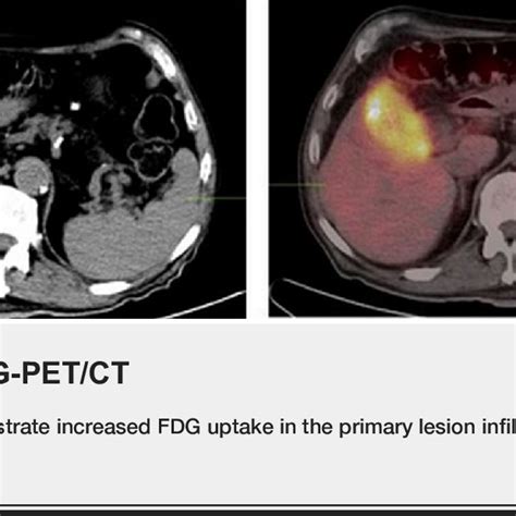 Pdf 18f Fdg Petct Imaging Of Gallbladder Adenocarcinoma A