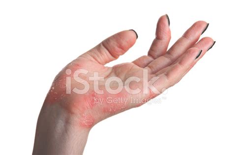 Psoriasis Hand Stock Photos