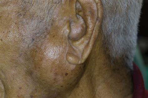 Parotid Gland Tumor Causes Side Effects And Treatments At