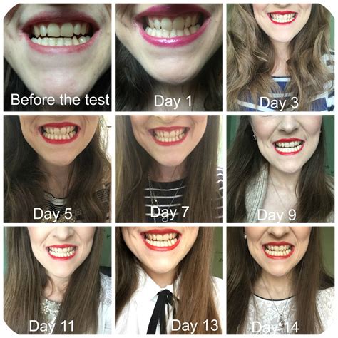 Teeth whitening pens are a popular method for whitening your teeth. Get whiter teeth in 2 weeks with Colgate teeth whitening pen