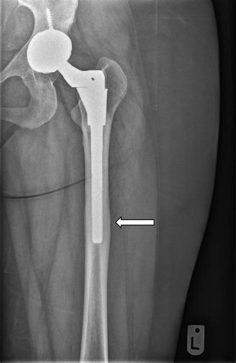 Cureus Cortical Strut Graft For Enigmatic Thigh Pain In Uncemented