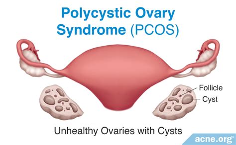 What Is Polycystic Ovary Syndrome Pcos And How Does It Affect Acne