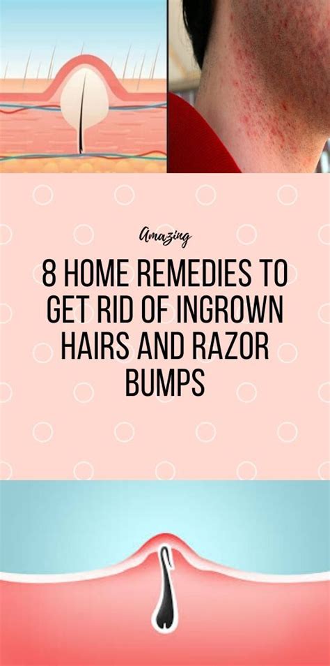 8 Home Remedies To Get Rid Of Ingrown Hairs And Razor Bumps Health Clean
