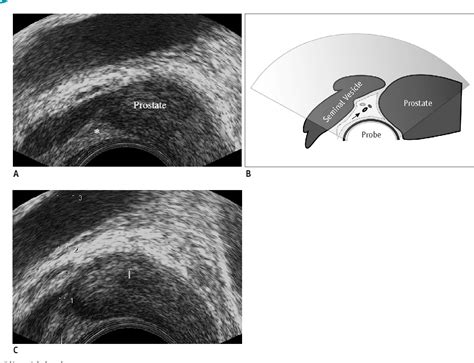 Figure 1 From Pain During Transrectal Ultrasound Guided Prostate Biopsy
