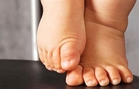 What Cause In Toeing And Out Toeing In Toddlers Child Development