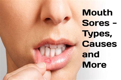 Mouth Sores Types Causes And More