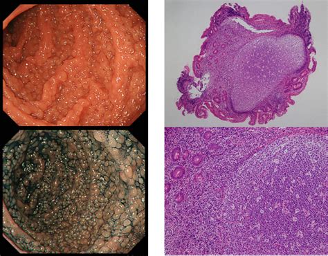 Duodenal Nodular Lymphoid Hyperplasia In A Patient With Iga Deficiency