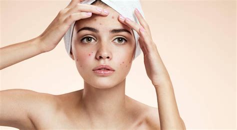 Acne Treatments For Sensitive Skin Everything You Need To Know