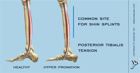 Anterior Tibialis Tendinitis And Pronation Mass4d Foot Orthotics