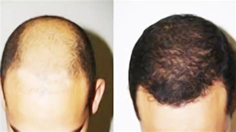 How To Make Hair Grow On Bald Head Naturally A Comprehensive Guide