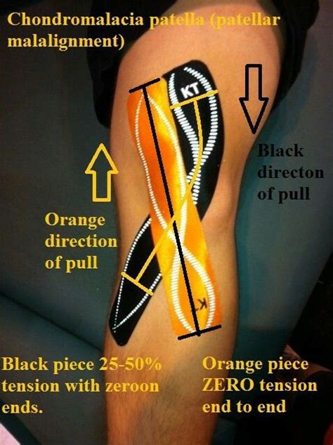 Patellar Taping Body Health Health Fitness Workout Fitness Knee