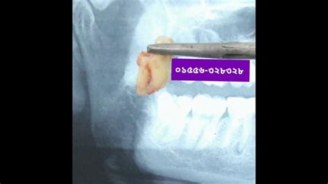 Surgical Extraction 3rd Molar Youtube