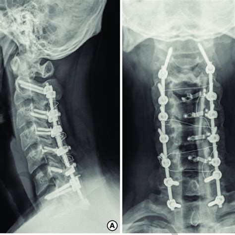 A Recent Plain Radiograph Of The Cervical Spine Lateral View A