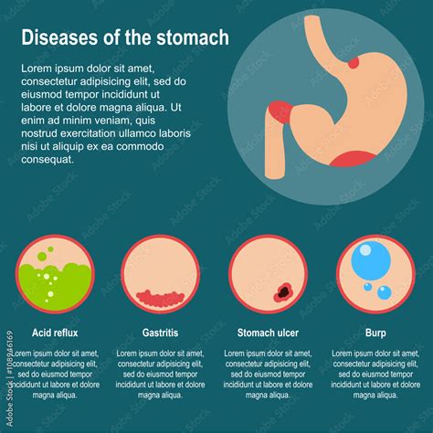 Diseases Of The Stomach Vector Illustration Damage To The Stomach