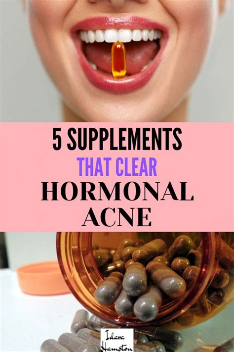 Is Hormonal Acne Driving You Crazy Im Going To Share Five Of My
