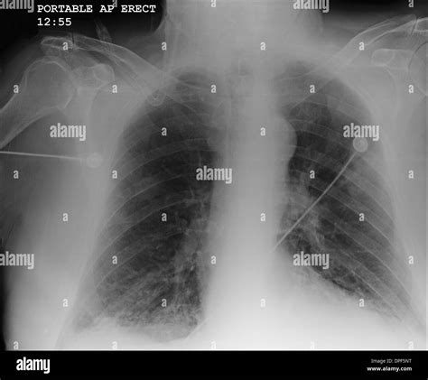 X Ray Of Chest Showing COPD Stock Photo Alamy