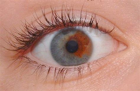 Olhos De Cores Diferentes Na Mesma Pessoa Sobre Os Olhos