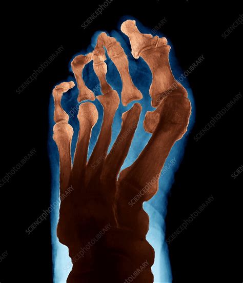 Arthritic Foot X Ray Stock Image M1100482 Science Photo Library