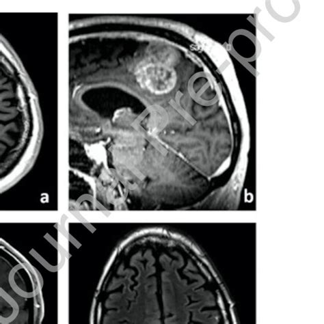 Preoperative Mri A Axial T1 Mri After Administration Of Gadolinium