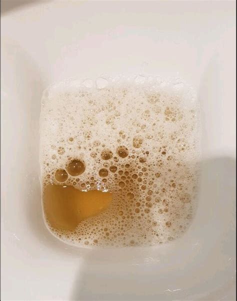 Persistently Foamy / Bubbly Urine
