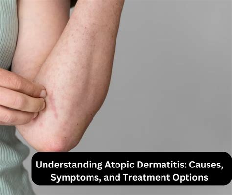Understanding Atopic Dermatitis Symptoms And Treatment