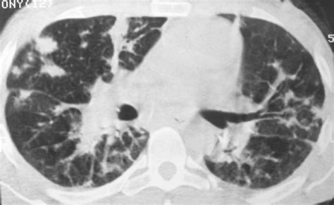 High Resolution Ct Scan At The Level Of The Main Bronchi Of A Patient