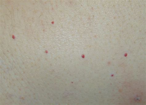 Small Red Dots On Skin Dorothee Padraig South West Skin Health Care