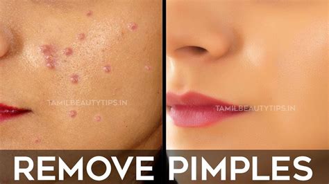 5 Tips How Remove Pimples And Pimple Marks