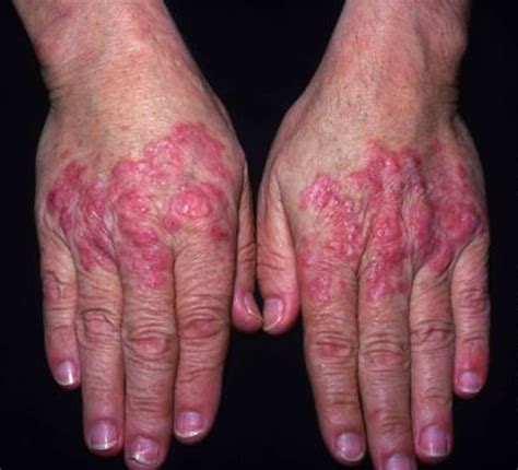 Lupus Hand Erythema And Hand Oedema By Lupus Vasculitis Download