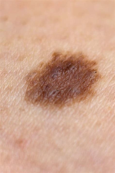 Skin Cancer Moles On Back Idaman