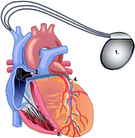 Cardiac Pacemaker Clipart 20 Free Cliparts Download Images On