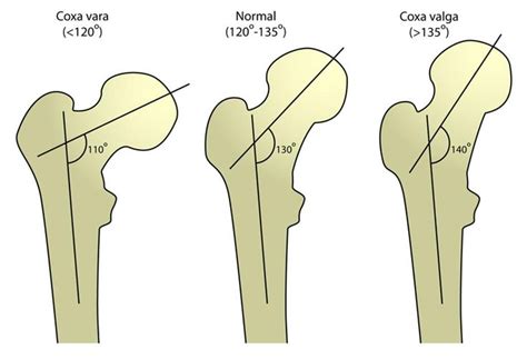 Coxa Vara And Coxa Valga Diagram Radiology Case