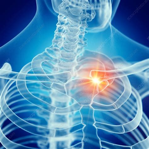 Illustration Of A Painful Clavicle Stock Image F0237924 Science