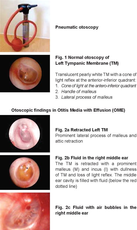 Figure 1 From Management Of Otitis Media With Effusion In Children With