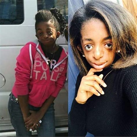 Sweet Pikin Girl Born With Facial Deformity Saysconfidence Is Sexy Photos