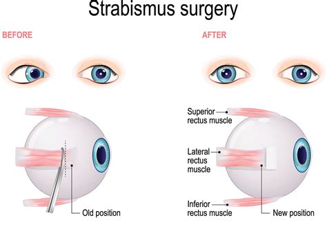 strabismus and amblyopia azar eye clinic