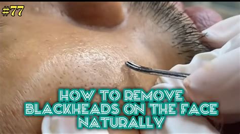 Satisfying Videos Pimples Popping Blackheads Acne And Cysts