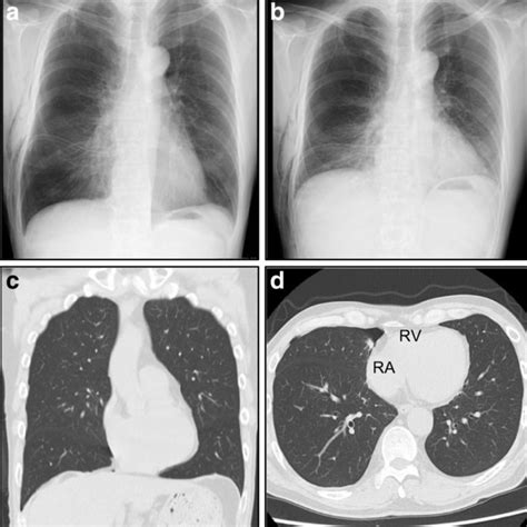 Follow Up Chest Radiographs And Computed Tomography Scans Of The